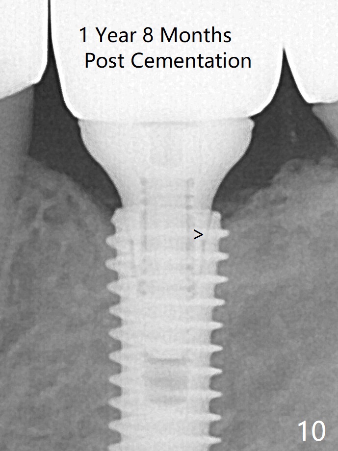 Non Immediate Implant of Lower 1st Molar with Ridge Split, Duluth